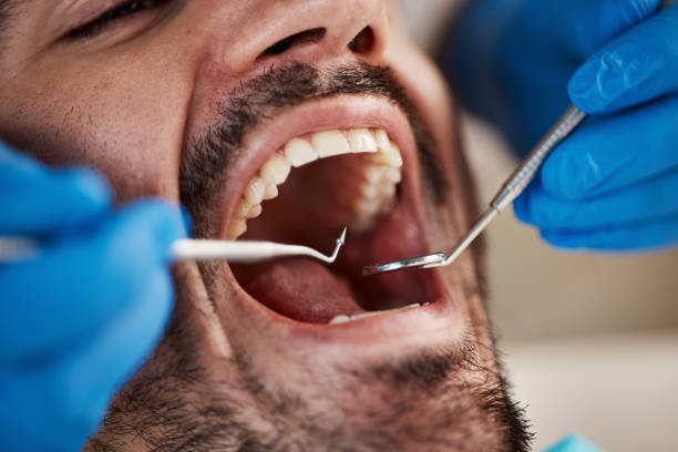 Best Knocked-Out Tooth (Avulsed Tooth) Treatment in Bethany, IL